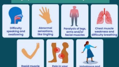 Prevalence of Guillain-Barre Syndrome (GBS). Symptoms and treatment 20 Prevalence of Guillain-Barre Syndrome (GBS). Symptoms and treatment